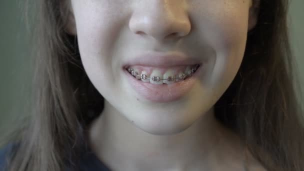 Fechar - para cima da boca de uma jovem com aparelho, que sorri amplamente e mostra os dentes com aparelho de metal. Conceito. 4k. — Vídeo de Stock