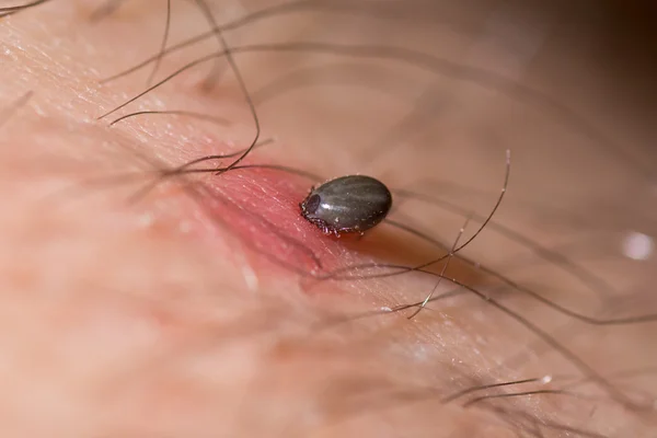 Engorged tick biting man's arm