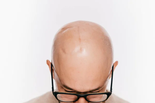 Closeup Bald Male Head Oncology Operation Brain Tumor Irradiation Chemotherapy — Stock Photo, Image