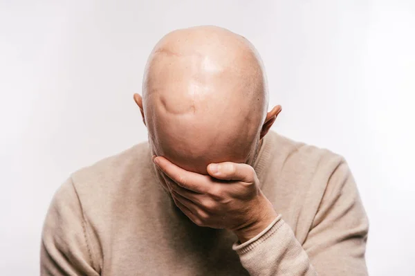 Plešatý Muž Psychologický Stres Bojující Doživotní Nádor Mozku Srdcervoucí Mužské — Stock fotografie