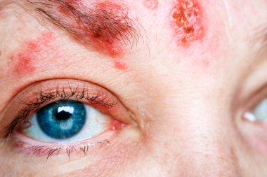 Yüzdeki ve Gözün çevresindeki kiremitlere göz zifti ya da herpes zoster ophthalmicus denir.