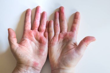 Ellerinde güçlü alerjik egzama var. Kırmızı, çatlamış derisi kabarcıklı.