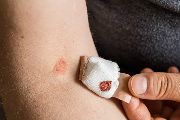 Marca Equimosis Después Extracción Sangre Persona Arrancando Parche Con Apósito —  Fotos de Stock