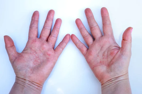 Dermatitis Atópica Manos Rojas Problema Dermatológico Manos Femeninas Alergia Picor —  Fotos de Stock