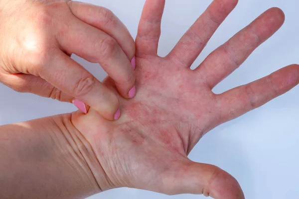Mujer Rascarse Las Manos Irritadas Dermatitis Atópica Mano Roja Problema —  Fotos de Stock