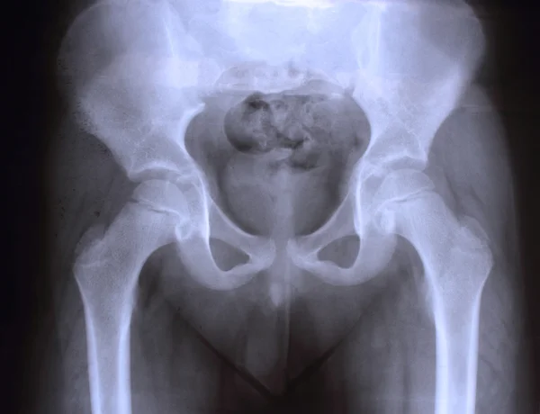 Radiografía de la pelvis y la columna vertebral de un adolescente — Foto de Stock