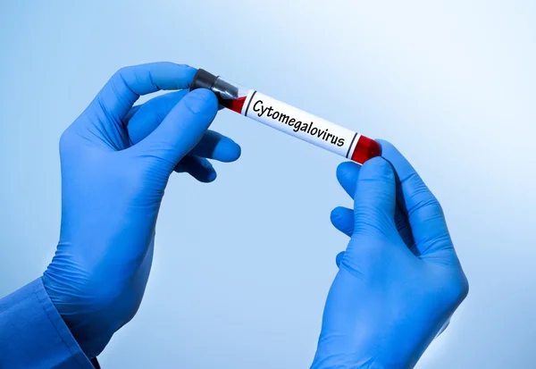 Positieve uitslag van bloedonderzoek voor cytomegalovirus. Test buis met een bloed test in handen van de arts. Medische concept. — Stockfoto