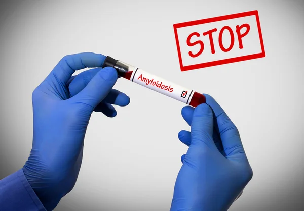 Stop amyloidosis. Pozitív vérvizsgálat eredménye. Kémcső egy vér teszt az orvos kezében. Egészségügyi koncepció. — Stock Fotó