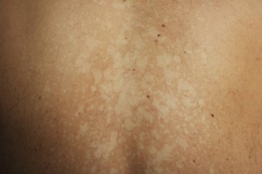 Tinea versicolor 'den etkilenen bir insanın yakın plan görüntüsü, deri pigmentasyonunun azalmasından kaynaklanan düzensiz beyaz hipopigmente yamaları gösteriyor