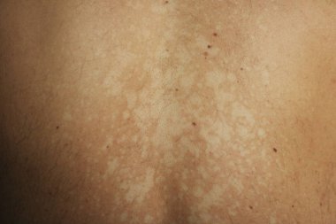 Tinea versicolor 'den etkilenen bir insanın yakın plan görüntüsü, deri pigmentasyonunun azalmasından kaynaklanan düzensiz beyaz hipopigmente yamaları gösteriyor