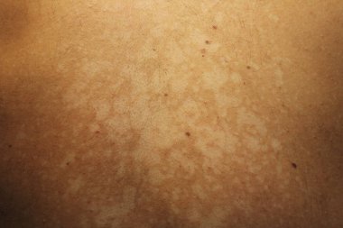 Tinea versicolor 'den etkilenen bir insanın yakın plan görüntüsü, deri pigmentasyonunun azalmasından kaynaklanan düzensiz beyaz hipopigmente yamaları gösteriyor