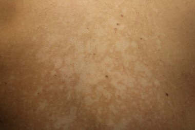 Tinea versicolor 'den etkilenen bir insanın yakın plan görüntüsü, deri pigmentasyonunun azalmasından kaynaklanan düzensiz beyaz hipopigmente yamaları gösteriyor
