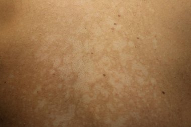Tinea versicolor 'den etkilenen bir insanın yakın plan görüntüsü, deri pigmentasyonunun azalmasından kaynaklanan düzensiz beyaz hipopigmente yamaları gösteriyor