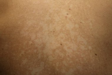 Tinea versicolor 'den etkilenen bir insanın yakın plan görüntüsü, deri pigmentasyonunun azalmasından kaynaklanan düzensiz beyaz hipopigmente yamaları gösteriyor
