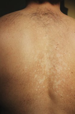 Tinea versicolor 'den etkilenen bir insanın yakın plan görüntüsü, deri pigmentasyonunun azalmasından kaynaklanan düzensiz beyaz hipopigmente yamaları gösteriyor