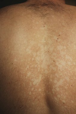 Tinea versicolor 'den etkilenen bir insanın yakın plan görüntüsü, deri pigmentasyonunun azalmasından kaynaklanan düzensiz beyaz hipopigmente yamaları gösteriyor