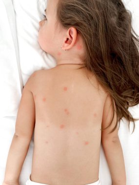 Sivrisinekler tarafından ısırılan çocuklar. Sırtında ısırık izleri var. Sivrisinekler ve böcekler tarafından ısırılan bir çocuk. Böcek ısırıklarına ve yaralara alerji için ilk yardım ve tedavi.