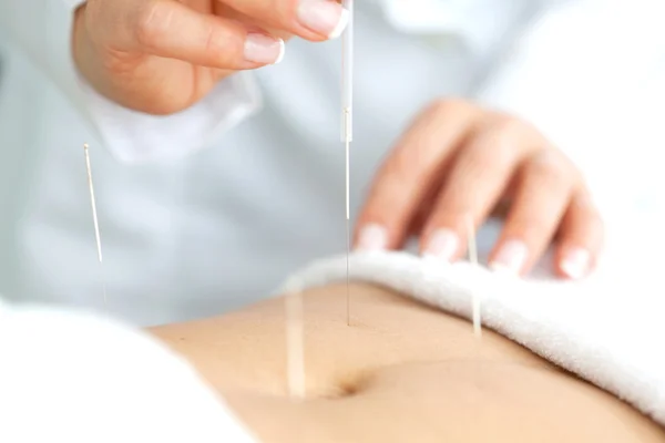 Abdominal akupunktur på patientens buk — Stockfoto