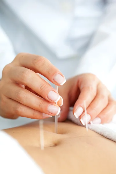 Médico aplicando acupuntura abdominal — Fotografia de Stock