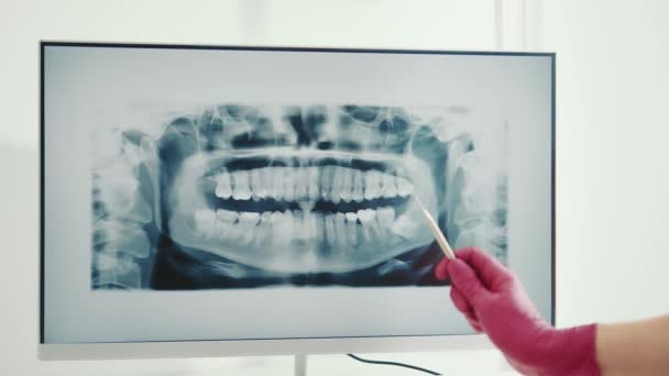 Dentysta bada panoramiczne prześwietlenie zębów. Dentysta pokazuje problem zębów na prześwietleniu zębów palcem.. — Wideo stockowe