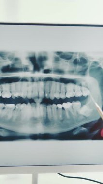 Dişçi dişlerin panoramik röntgenini inceler. Diş hekimi sorun dişlerini parmağıyla röntgende gösteriyor.