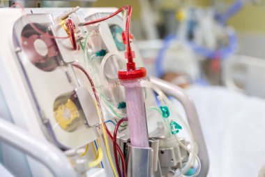 Diyaliz makinesi çalışıyor. Böbreklerin vücuttan atık taşımasının yerine geçiyor..