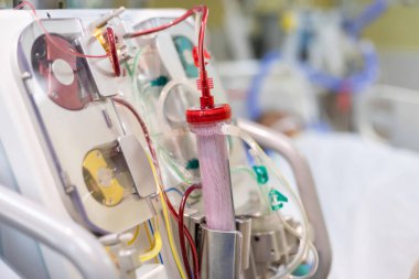 Diyaliz makinesi çalışıyor. Böbreklerin vücuttan atık taşımasının yerine geçiyor..