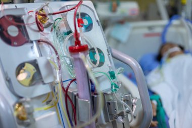 Diyaliz makinesi çalışıyor. Böbreklerin vücuttan atık taşımasının yerine geçiyor..