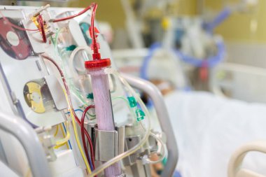 Diyaliz makinesi çalışıyor. Böbreklerin vücuttan atık taşımasının yerine geçiyor..