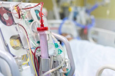 Diyaliz makinesi çalışıyor. Böbreklerin vücuttan atık taşımasının yerine geçiyor..