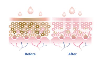 Melasma tedavisi öncesi ve sonrası vektör çizimi beyaz arka planda izole edildi. Melasma derisi ve derinin çapraz kesiti hiperpigmentasyonu, koyu benekleri ve hasarlı deriyi azaltmaya yardımcı olur..