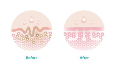 Cilt bakımı öncesi ve sonrası kırışıklık vektör simgesi çizimini azaltır. Cilt ve cilt kırışıklıklarının çapraz kesimi yaşlanmayı ve zarar görmüş deriyi azaltmaya yardımcı olur. Cilt bakımı ve güzellik kavramı.