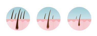 Kafa derisi katmanı vektör simgesi ile saç dökülme aşamaları beyaz arka planda izole edilmiş. Azalt, azalt, zayıfla, düş, kök kılları dökülmeye ve kelliğe. Saç bakımı ve anatomi konsepti.