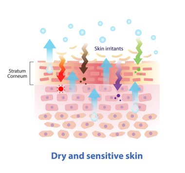 Kuru ve hassas deri çizimi yapısı. Boşluklarla dolu stratum korneum içinde hücresel lipidler. Su ve yağ miktarı yetersiz. Sebum film cilt tahriş edicilerden koruyamaz.