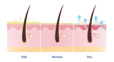 Yağlı, normal ve kuru cilt vektör illüstrasyonu karşılaştırması. Deri aşırı yağlı cilt üretimi, normal cilt nemlendirici, su kaybı ve kuru ciltte sebum eksikliği..