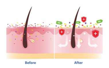 Prebiyotik, probiyotik ve postbiyotik cilt bakımı öncesi ve sonrası vektör illüstrasyonu. Kuru, tahriş edilmiş, kırmızı deri tabakası ve iyi bakteriler deri bariyerini destekliyor ve mikrobiyomu yeniliyorlar..