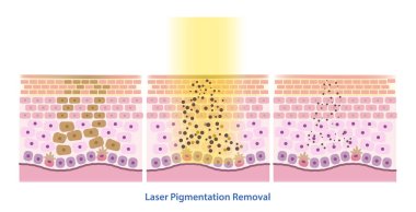 Lazer pigmentasyonu ve melasyon tedavisi çizimleri. Derinin altındaki koyu noktalar, lazer pigmentleri daha küçük parçalara ayırır ve hücresel mekanizma daha küçük pigmentleri daha etkin bir şekilde kaldırır..