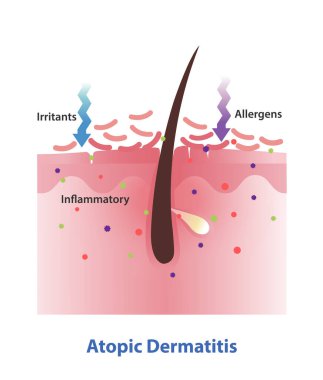 Deri tabakası illüstrasyonunda dermatit. Egzamanın enine kesiti, aşırı kaşınmaya, kızarıklığa ve iltihaplı deriye neden olur. Genetik ve çevresel faktörler bu duruma yol açar. Cilt bakımı kavramı.
