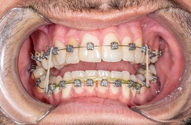 Diş ortodonti hastası vaka adamı. Metal parantezli, metal telli ve elastik çene arası zincirleri olan açık oyun salonlarının önü. Gingiva sakızı, yanak açıcı ve bıyık kılı..