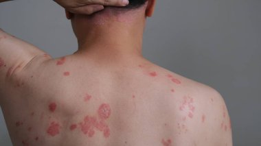 Sırtında ve boynunda kronik Gutate Sedef Hastalığı olan bir adam..