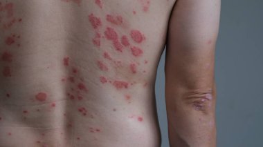 Sırtında kronik Guttate Sedef hastalığı olan bir adam..