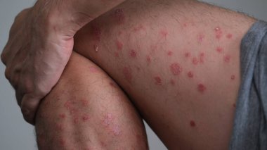 Derideki kızarıklığın ilk belirtileri kuruyup alevlenerek bacağındaki sedef hastalığına dönüşür..