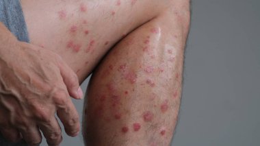 Derideki kızarıklığın ilk belirtileri kuruyup alevlenerek bacağındaki sedef hastalığına dönüşür..