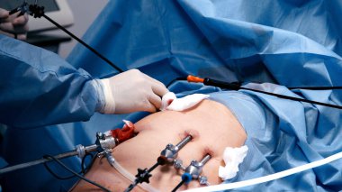 Mavi önlüklü cerrah laparoskopik cerrahi yürütüyor. Steril bir ortamda gelişmiş tıbbi gereçleri kullanarak beceri ve odaklanma gösteriyor.