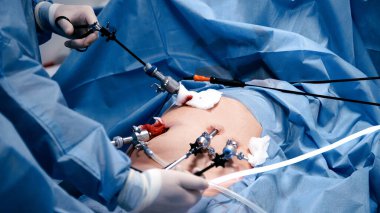 Tıp uzmanları laparoskopik cerrahi için özel aletler kullanırlar. Gelişmiş teknolojilerle dolu temiz ve steril bir ameliyathanede hassasiyet ve takım çalışmasını vurgularlar.