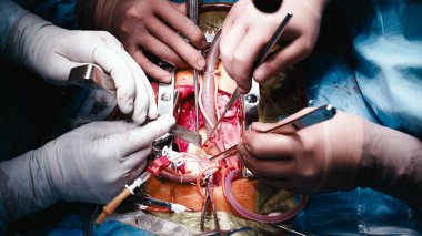 Gelişmiş ekipman ve steril çevre ile çevrili bir ameliyathanede kalp cerrahisi yapan tıp uzmanları, sağlık hizmetlerinde takım çalışması ve hassasiyeti vurguladılar.