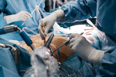 Mavi önlük ve eldiven giyen bir kalp cerrahı ameliyat sırasında bir hasta üzerinde cerrahi aletler kullanır ve arka planda tıbbi aletler ve ekipmanlar bulunur.