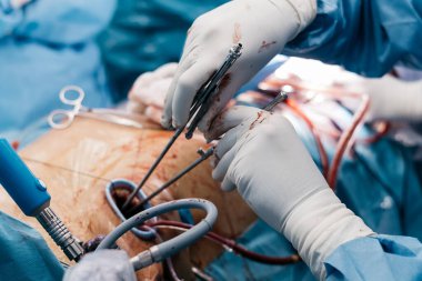 Eldiven ve mavi önlük giyen kalp cerrahı ameliyat sırasında ameliyat odasında çeşitli alet ve gereçlerle bir hasta üzerinde cerrahi aletler kullanır.