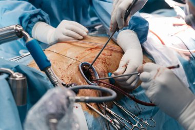 Açık kalp ameliyatı sırasında kalp kapakçığı yerleştirme işlemi devam ediyor. Ameliyat masasında mavi önlüklü bir cerrahi ekip ve çeşitli tıbbi gereçler bulunuyor.