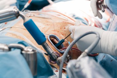 Kalp kapakçığı implantasyonu ameliyathanede yapılır, cerrahi aletler sergilenir ve hasta ameliyat masasında tıbbi personelle çevrilidir.